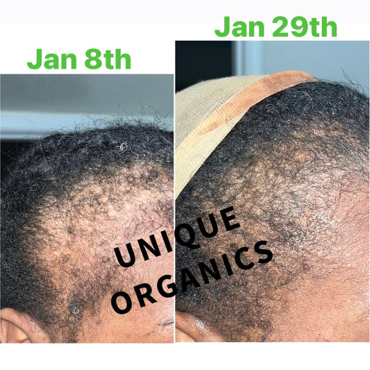 Ayurvedic Alopecia Hair Oil