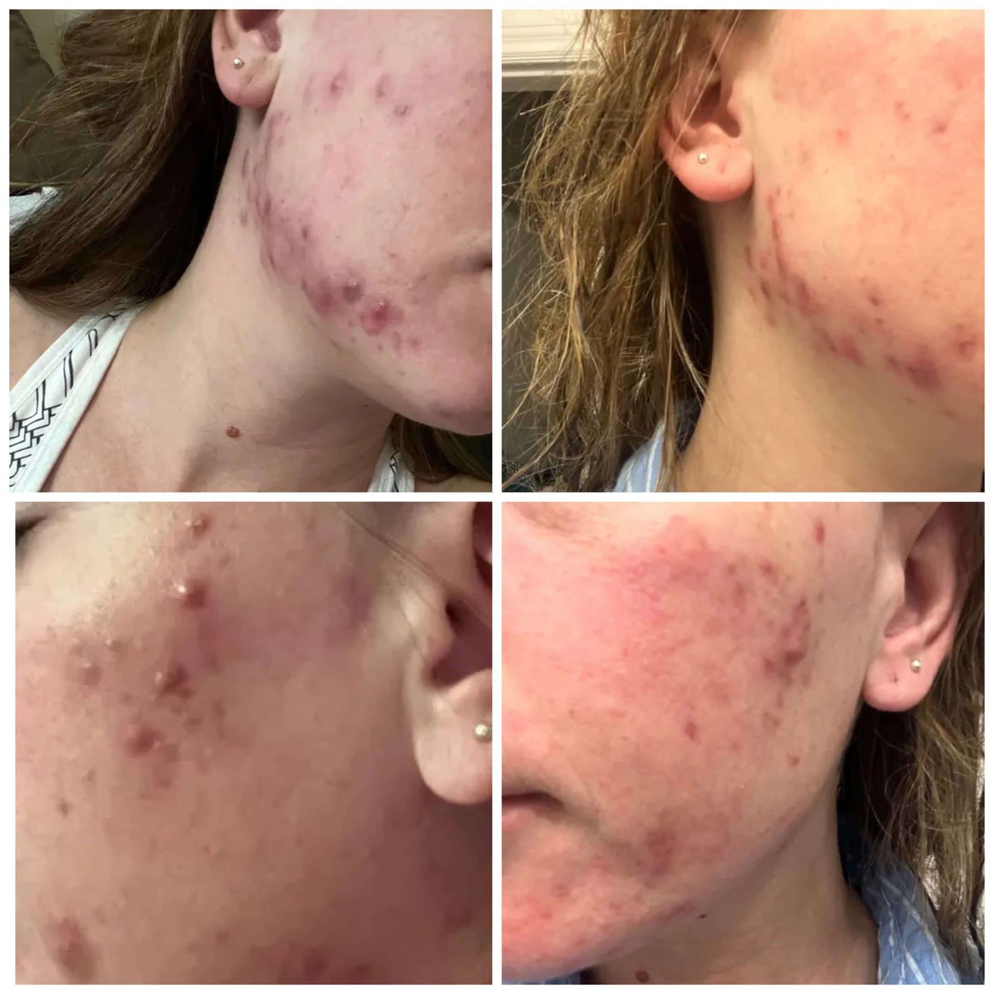 Rehab Serum: Pregnancy Acne Treatment