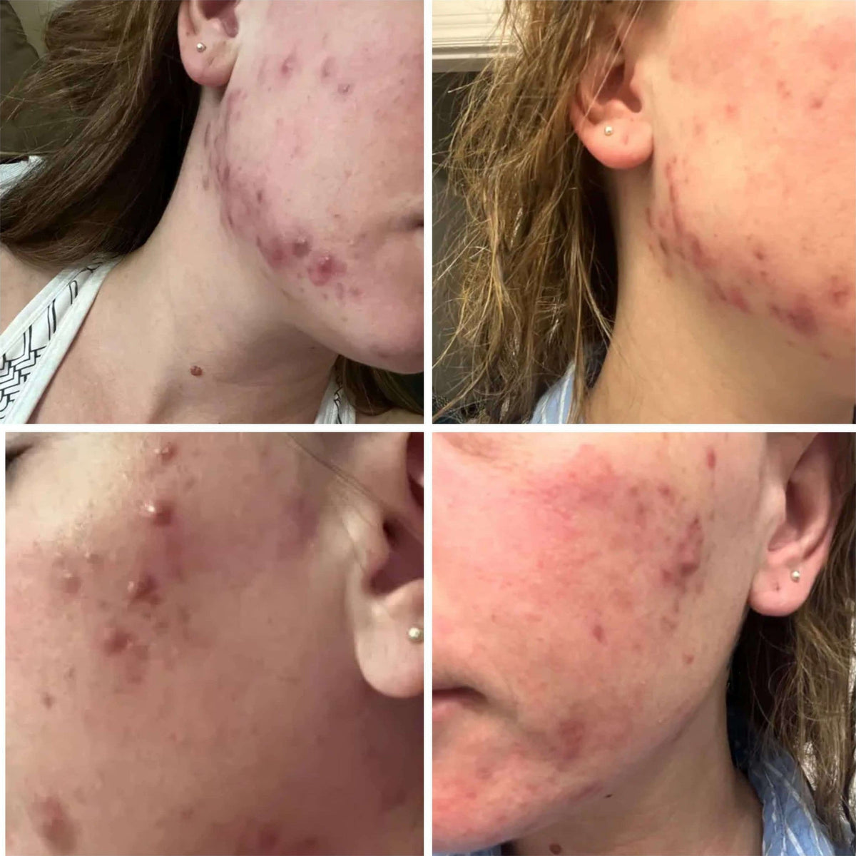 BalanC Toner - Peau nette et lumineuse | Toner anti-acné sans danger pendant la grossesse