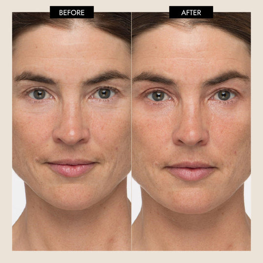 MyoLift Triwave Microcurrent Device