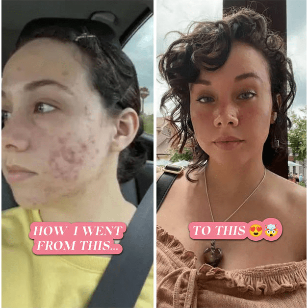 BalanC Toner - Peau nette et lumineuse | Toner anti-acné sans danger pendant la grossesse
