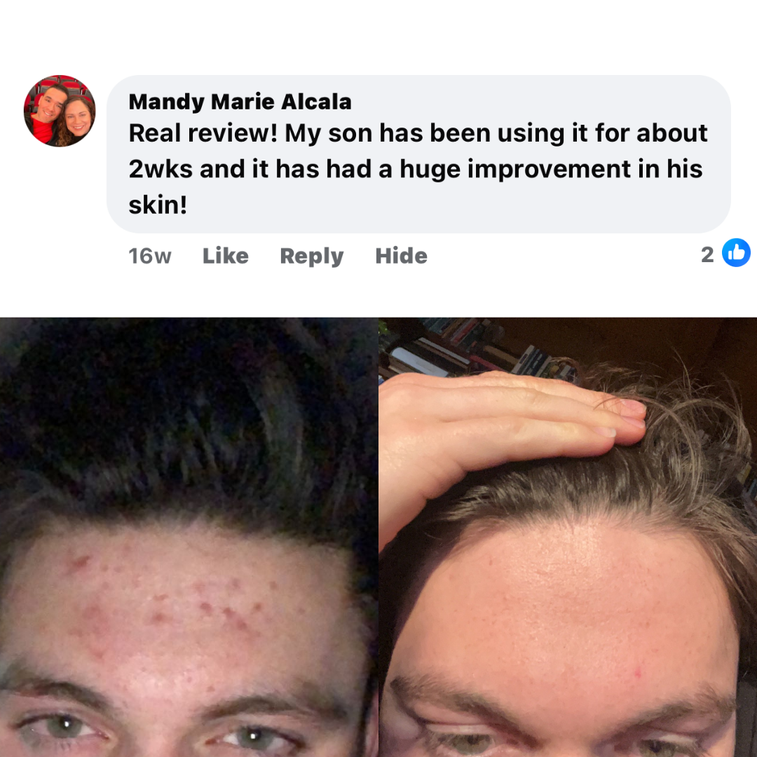 MVP Face Acne Scrubs