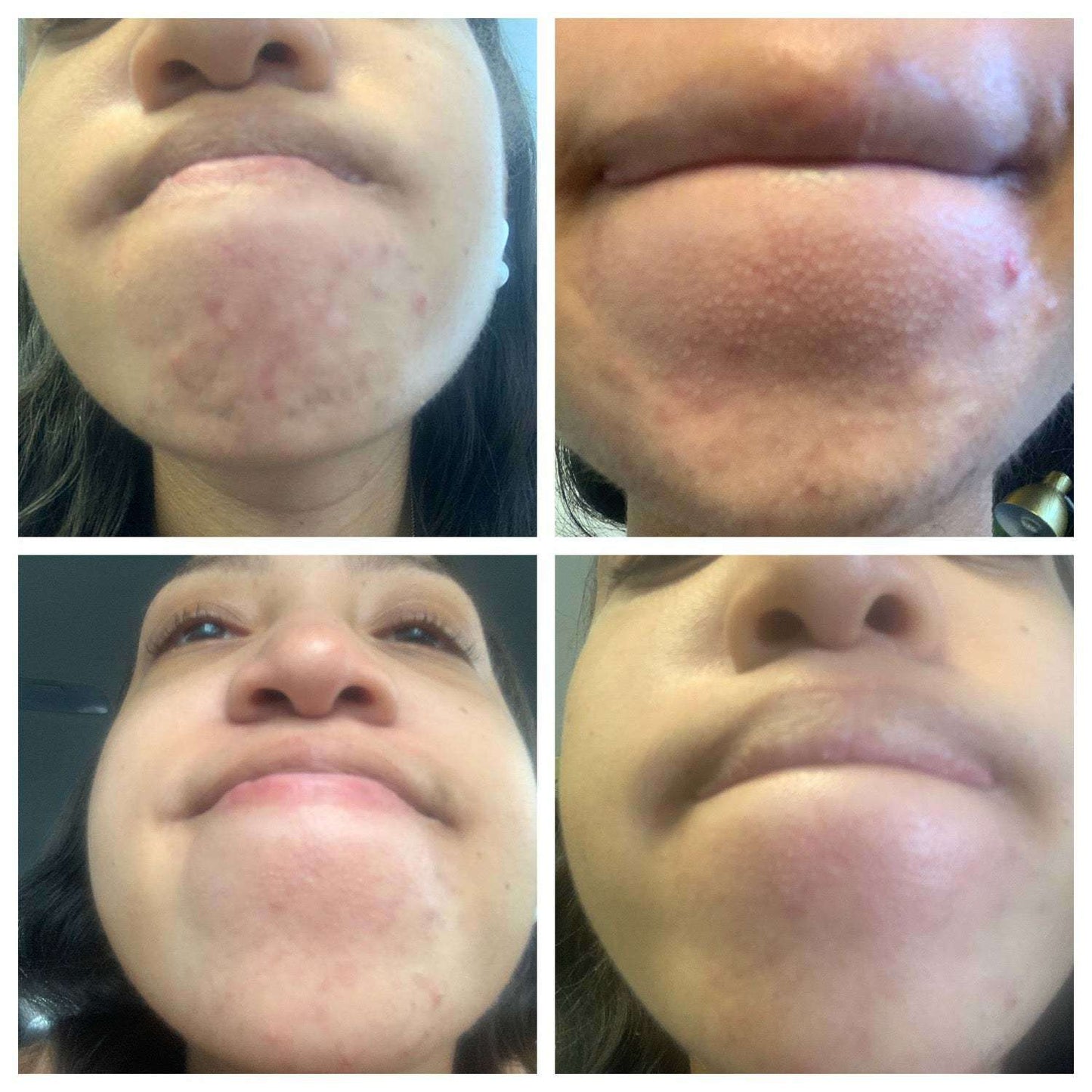 Rehab Serum: Pregnancy Acne Treatment