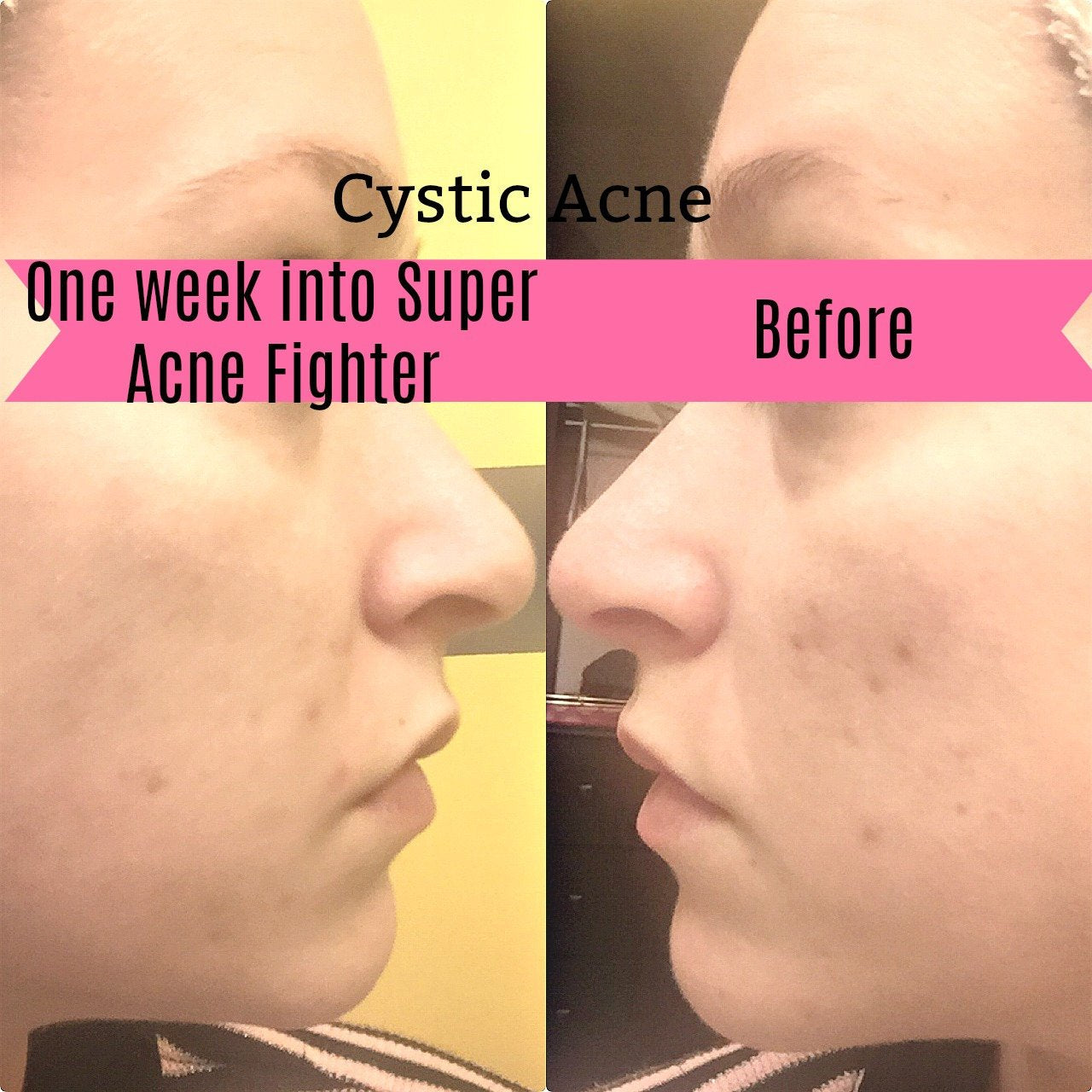 Super Acne Fighter / Organic Acne Treatment / Acne / Essential Oils / Natural Acne Treatment / Acne Scars / Hormonal Acne / Cystic Acne