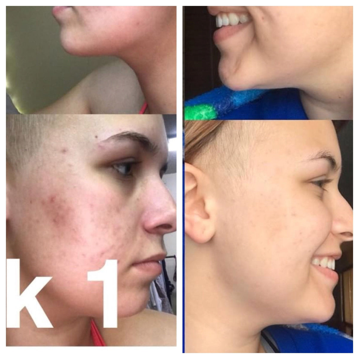 Super Acne Fighter