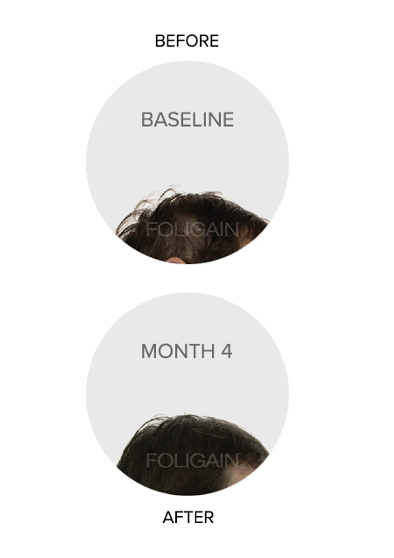 FOLIGAIN® Triple Action Complete Formula For Thinning Hair For Women with 10% TRIOXIDIL®