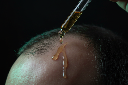 Topical minoxidil serum being applied to scalp with dropper for hair loss treatment