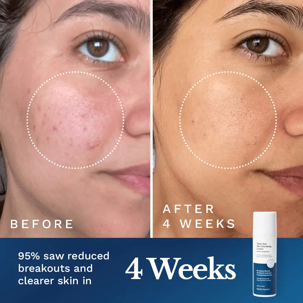 Clear Out Skin Clarifying Cream