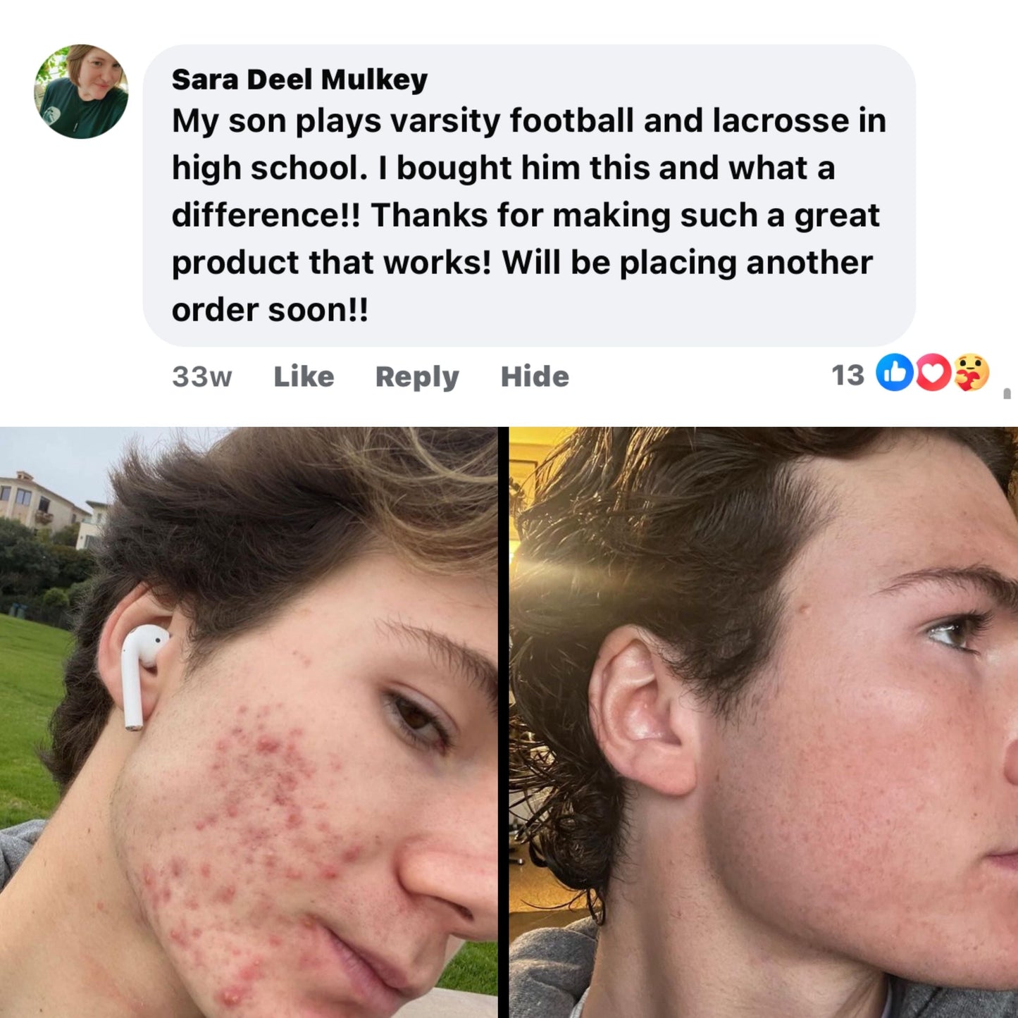 MVP Body Acne Scrubs