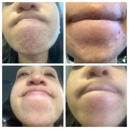 Rehab Serum: Pregnancy Acne Treatment