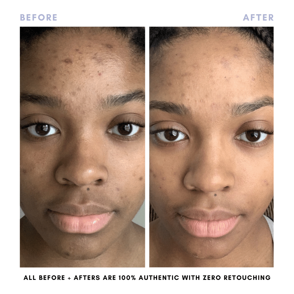 Sarah's Triple Threat | For Acne-Prone Maturing Skin