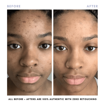 Sarah's Triple Threat | For Acne-Prone Maturing Skin