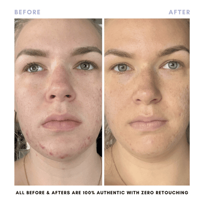 The Clear + Calm Skin Set | Acne + Skin Barrier Support Essentials
