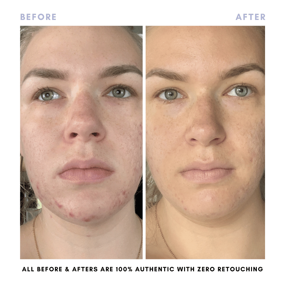 Sarah's Triple Threat | For Acne-Prone Maturing Skin