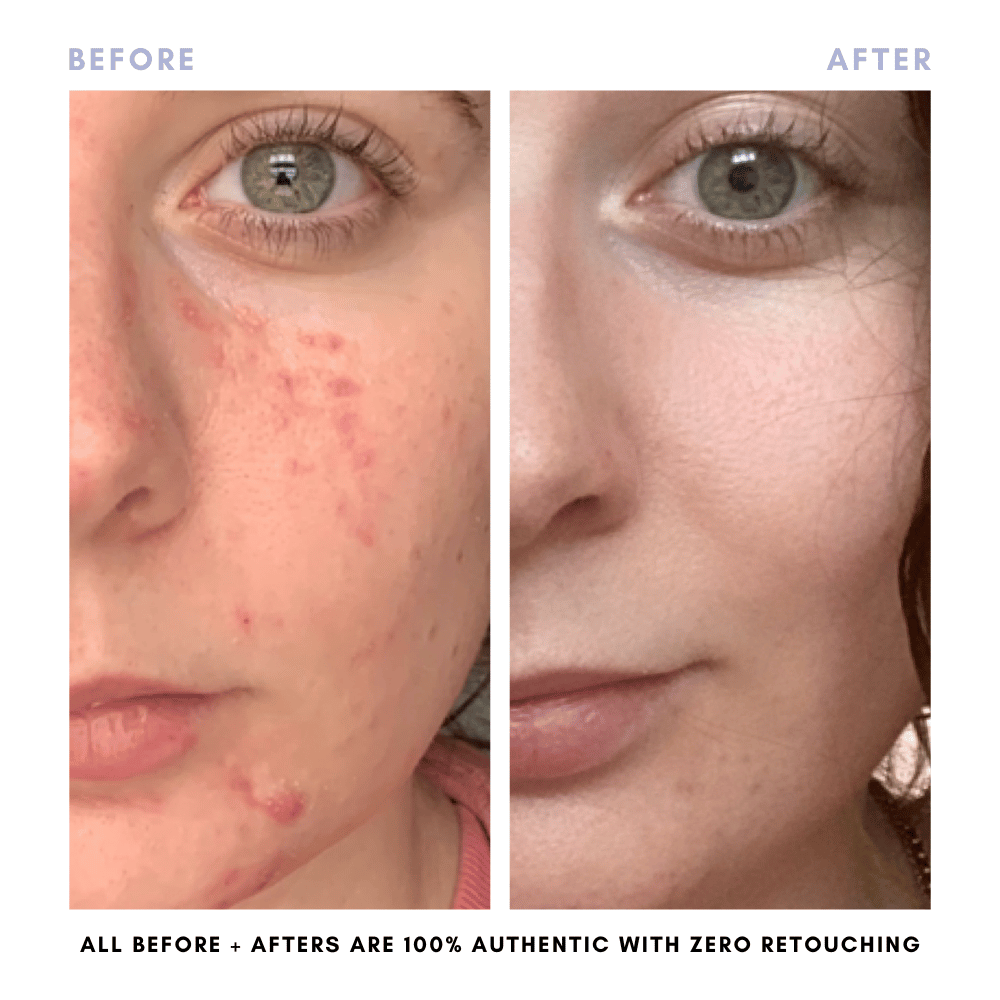 The Clear + Calm Skin Set | Acne + Skin Barrier Support Essentials
