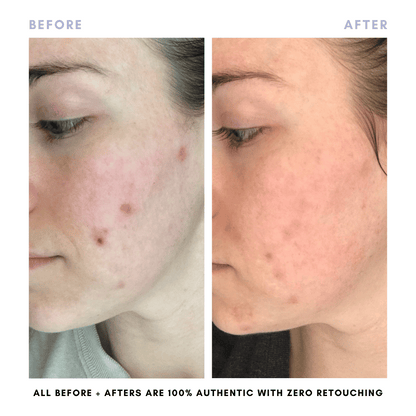 The Clear + Calm Skin Set | Acne + Skin Barrier Support Essentials