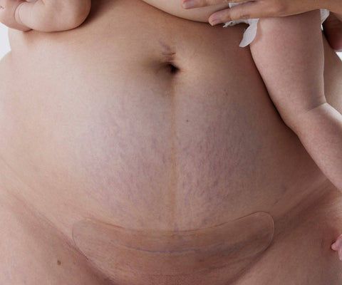 Bare Mum - Silicone Gel Scar Strips