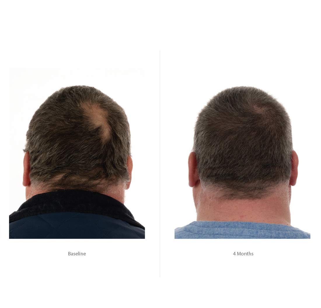 FOLIGAIN® Triple Action Conditioner For Thinning Hair For Men with 2% TRIOXIDIL®