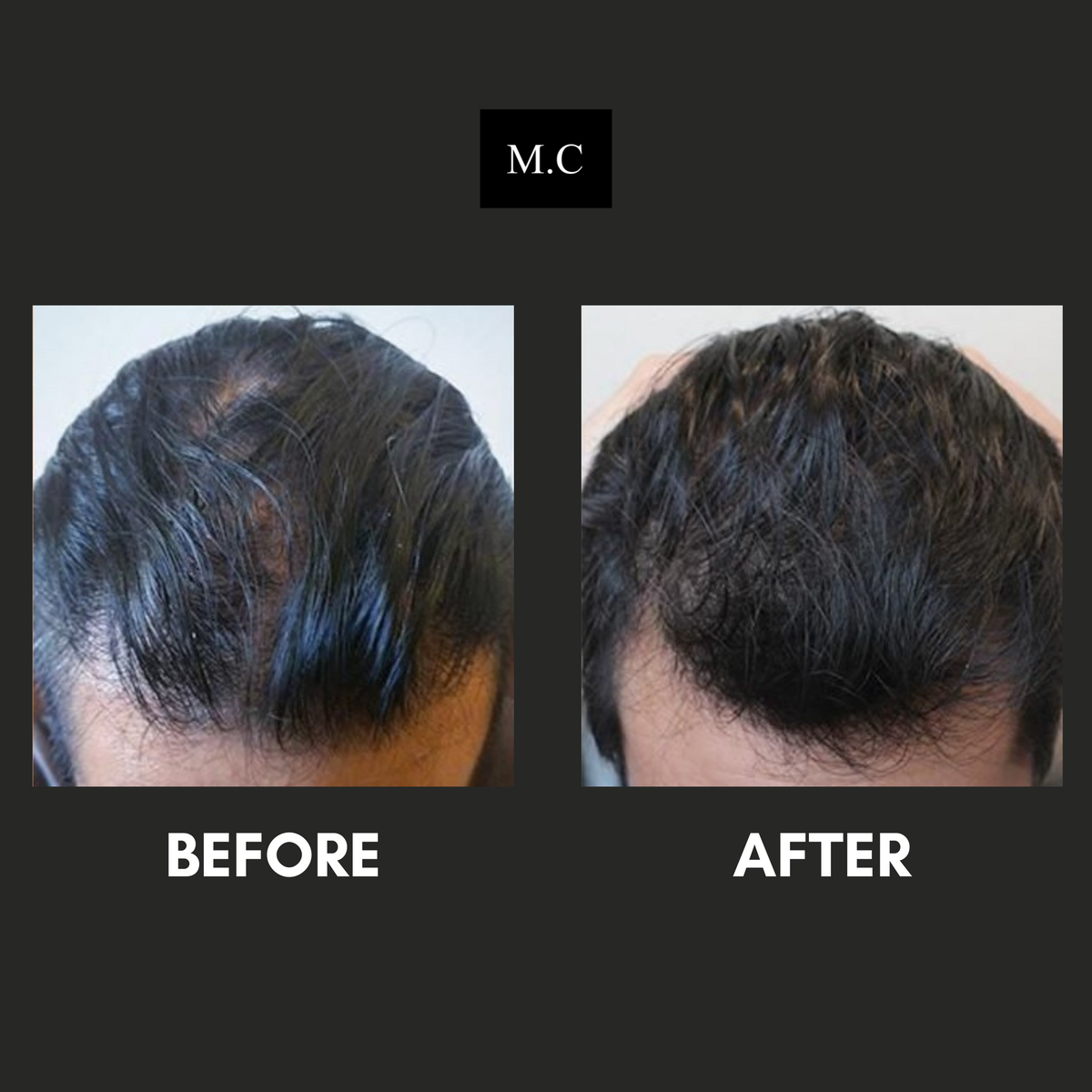 Jacob’s Natural Hair Growth Kit