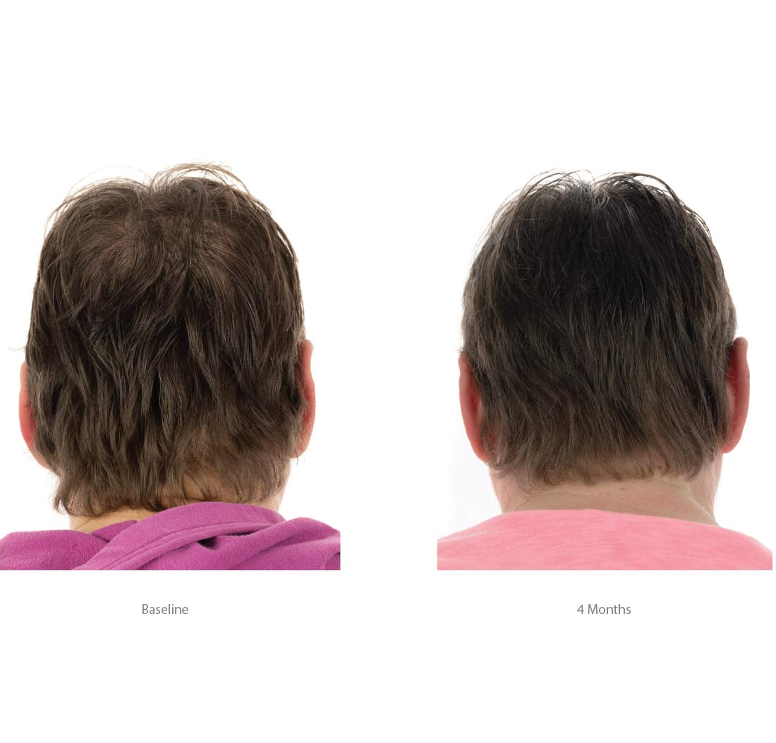 FOLIGAIN® Triple Action Shampoo For Thinning Hair For Women with 2% TRIOXIDIL®