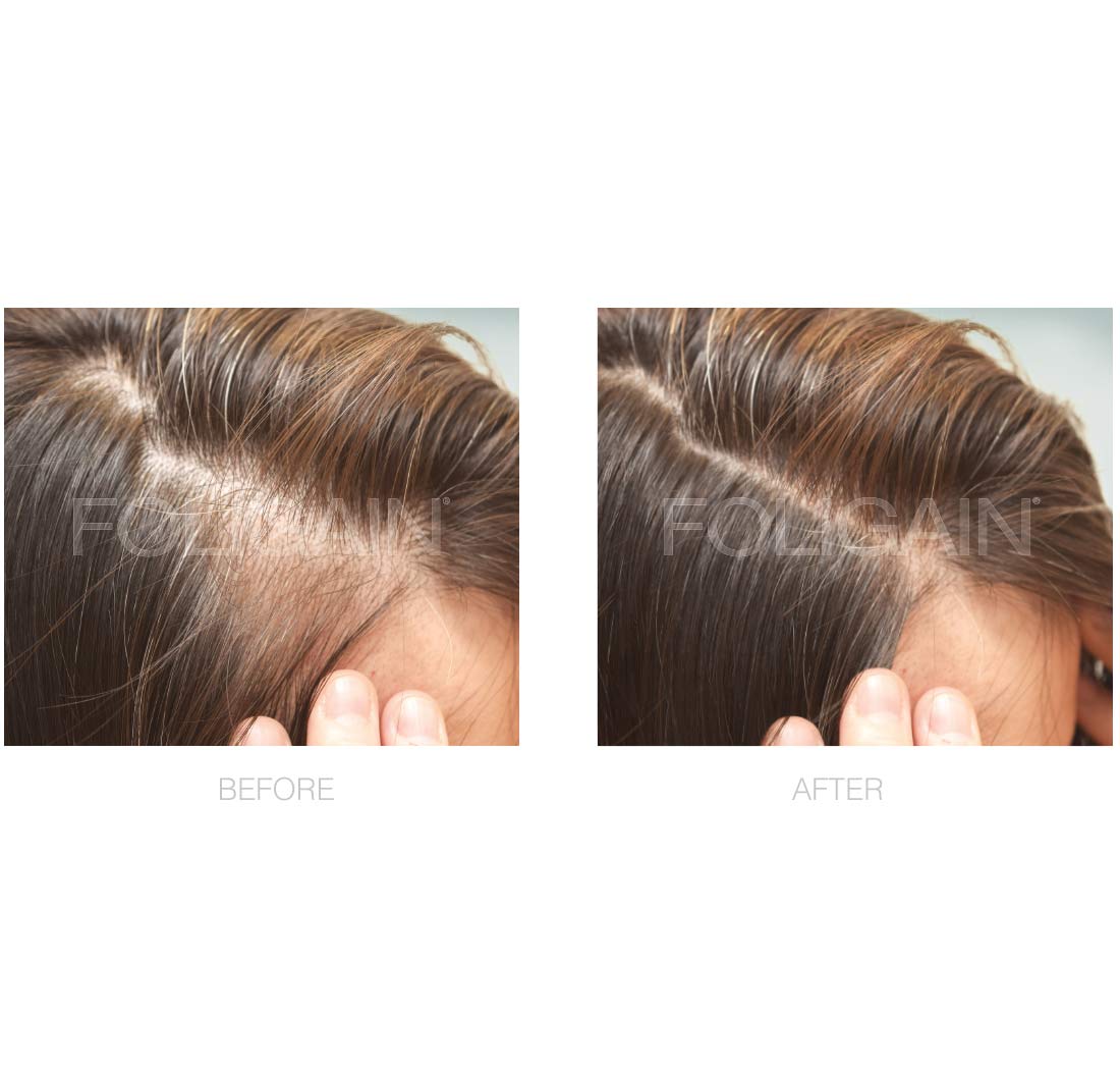 FOLIGAIN® Minoxidil 2% Hair Regrowth Treatment For Women 3 Month Supply